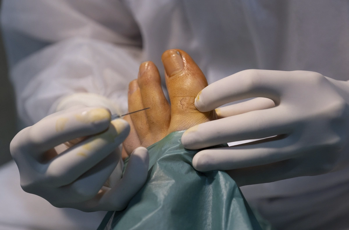 manos con aguja para operar pie