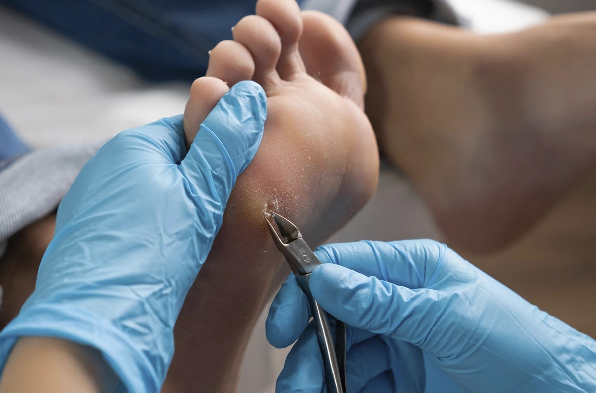 manos quitando durezas de planta del pie